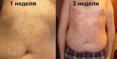 Розовый лишай на теле