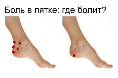 Варианты боли в пятке - разные причины боли
