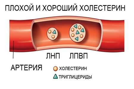 Рисунок хороший холестерин и плохой холестерин Рисунок хороший холестерин и плохой холестерин