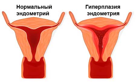 Гиперплазия эндометрия