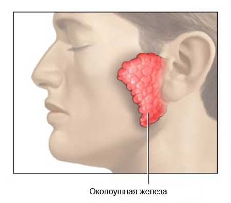 Рисунок: свинка поражает околоушные слюнные железы