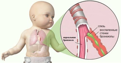 Бронхиолит у детей: симптомы, лечение и профилактика