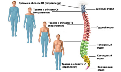 Травма спинного мозга