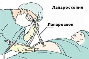 лапароскопия