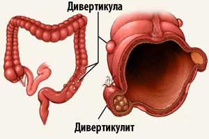 дивертикулез и дивертикулит