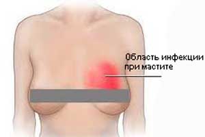 мастит