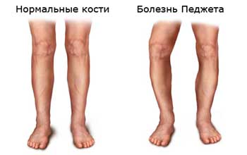  Болезнь Педжета - фото ног 