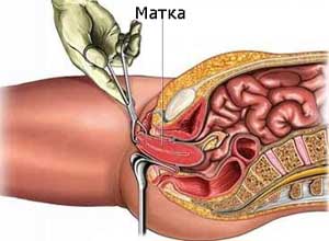 Гистерэктомия, или удаление матки