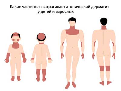 Схема атопического дерматита у детей и взрослых