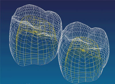 Зубные протезы: компьютерное моделирование