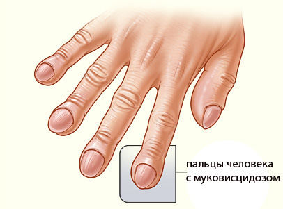 пальцы человека с муковисцидозом