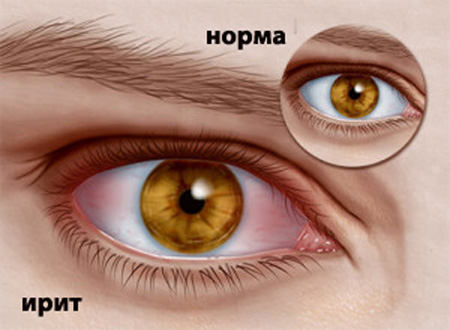 Осложнение болезни Бехтерева Ирит