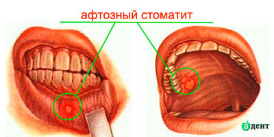 Афтозный стоматит: диагностика и лечение