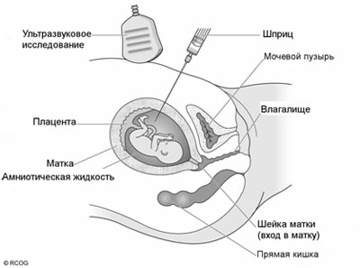 Амниоцентез
