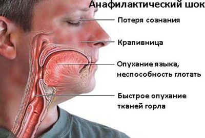 Анафилактический шок