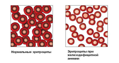 Анемия: лечение, диагностика, основные типы