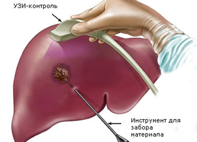 Биопсия печени: цель, описание, риски
