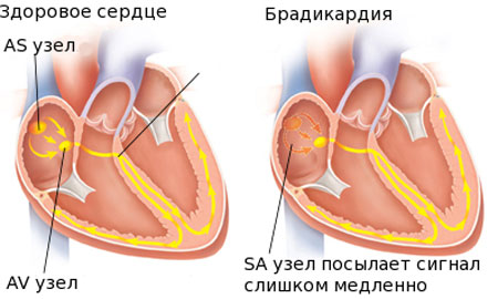 Брадикардия: лечение народными средствами