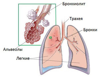 Что такое бронхиолит