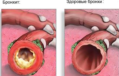 Как лечить бронхит у детей народными средствами