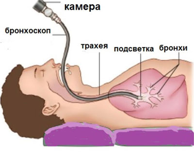Бронхоскопия: что это за процедура и как проводится
