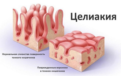 Целиакия