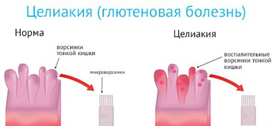 Целиакия у детей