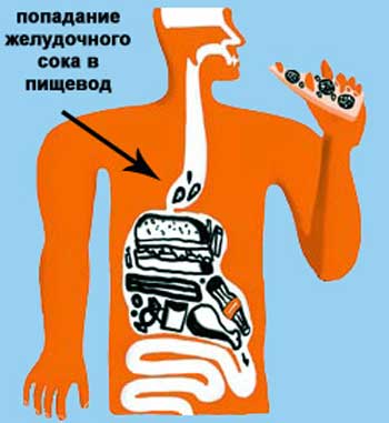 Бессимптомный рефлюкс
