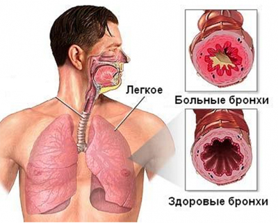 Профилактика и лечение бронхита