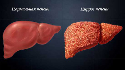 Гепатомегалия печени: признаки и лечение