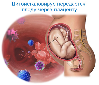Цитомегаловирусная инфекция