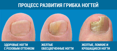 Лечение грибка ногтей народными средствами