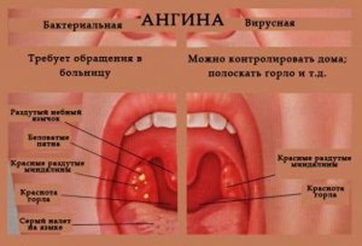 Как распространяется ангина
