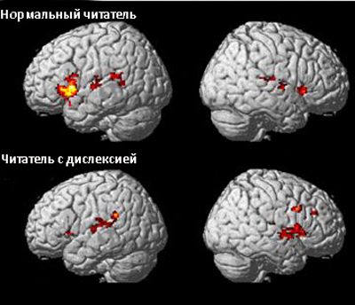 Дислексия: причины, диагностика, симптомы, коррекция
