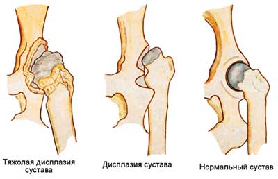 Врожденная дисплазия тазобедренного сустава