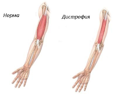 Мышечная дистрофия