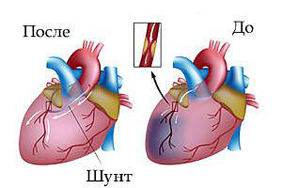 Коронарное шунтирование сосудов сердца
