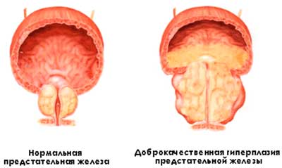Рак предстательной железы