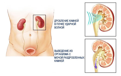 Дробление камней в почках