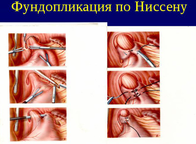 Гастроэзофагеальная рефлюксная операция