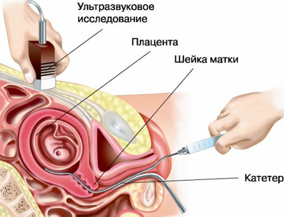Эндоскопия плода
