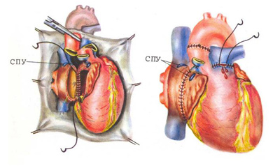 Трансплантация сердца