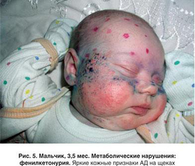 Метаболические заболевания