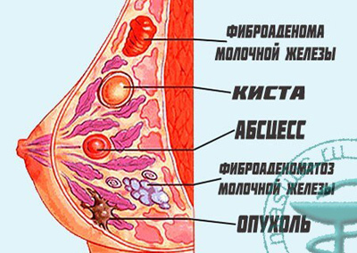 Заболевания молочной железы