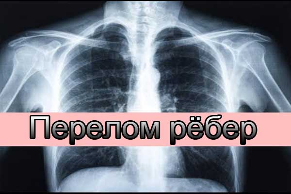 Что делать после перелома рёбер Что делать после перелома рёбер