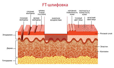Лазерная шлифовка кожи