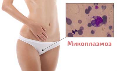 Микоплазмоз
