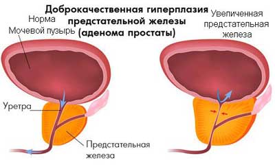 Трансуретральная резекция предстательной железы