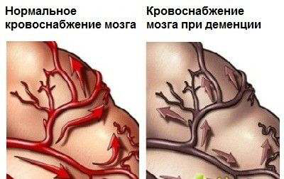 приобретенное слабоумие