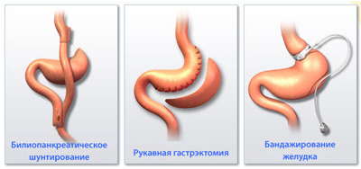 лечение ожирения